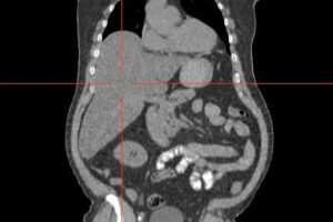 Jugo de Papa para combatir la Hernia Hiatal Naturalmente