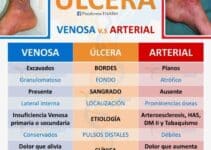 Plantas Medicinales para Ulceras Varicosas
