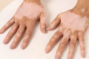 Plantas Medicinales para el Vitiligo